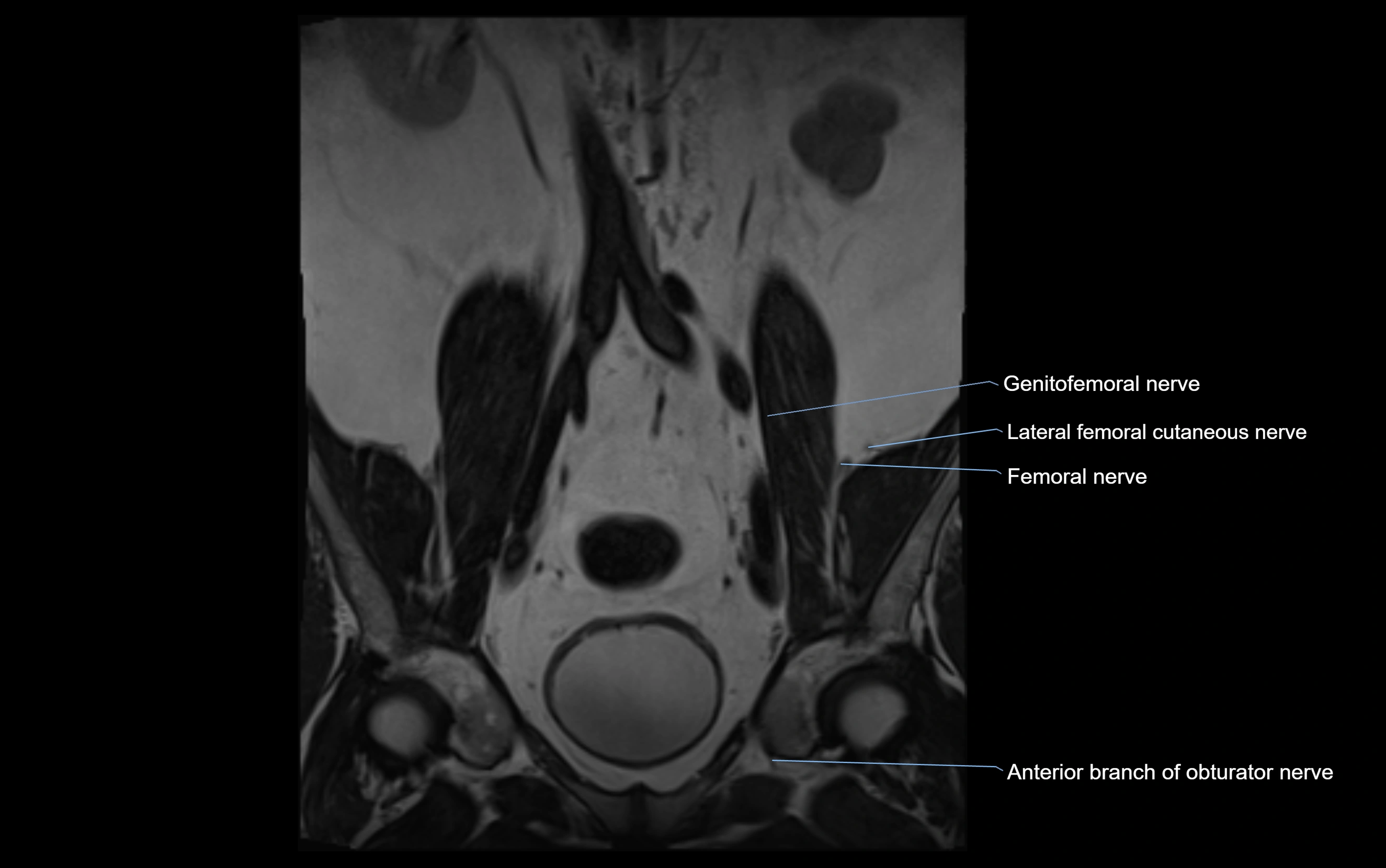 MR lumbosacral plexus cross sectional anatomy 3T  radiology  image-img-09001-00008.webp